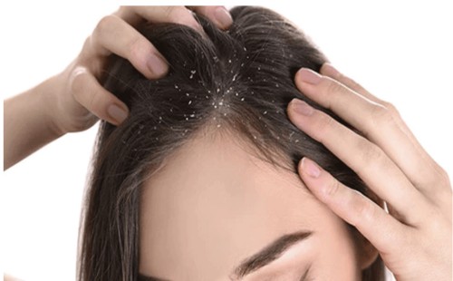 শীতে মাথায় খুশকি? সমাধান আছে... 