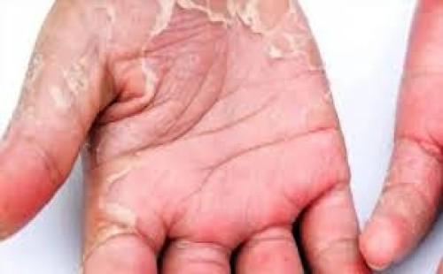 শীতে হাতে চামড়া ওঠে? প্রতিকার কী? 