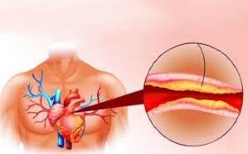 কোলেস্টেরল দূর করতে যা করবেন 