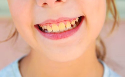 দাঁতের হলদে দাগ দূর করতে সাহায্য করবে ফল 