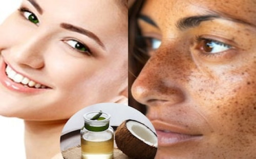 মুখের কালো দাগ দূর করবে নারকেল তেল, ব্যবহার করতে হবে যেভাবে 