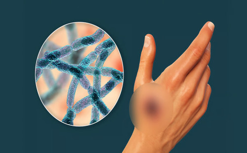 অ্যানথ্রাক্স আক্রান্ত গরুর মাংস কাটার সঙ্গে যুক্ত আরও ৭ জনের উপসর্গ শনাক্ত 